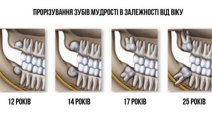 Скільки росте зуб мудрості?