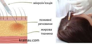 Процедура мезотерапії волосся