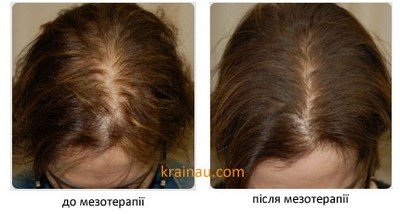 Мезотерапія до і після